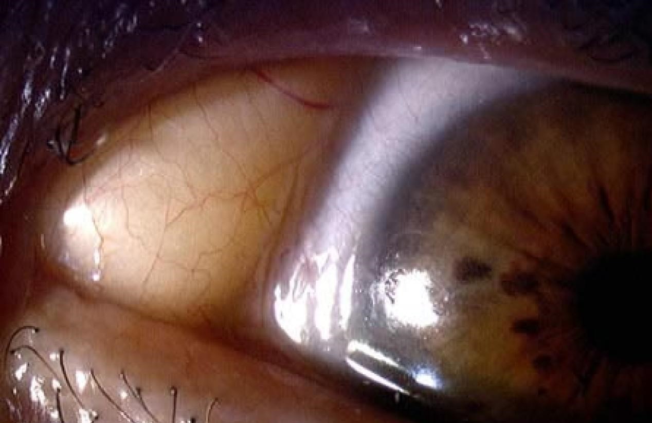 Clinical eye photograph illustrating Dermolipoma Limbal Conjunctival Mass