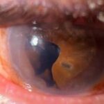 Clinical eye photograph illustrating Descemet Membrane Folds Striae