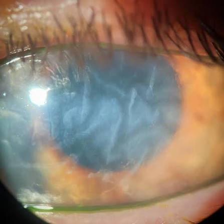Clinical eye photograph illustrating Descemet Membrane Folds Striae
