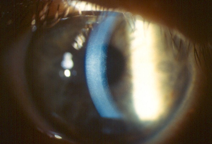 Clinical eye photograph illustrating Descemet Stripping Only
