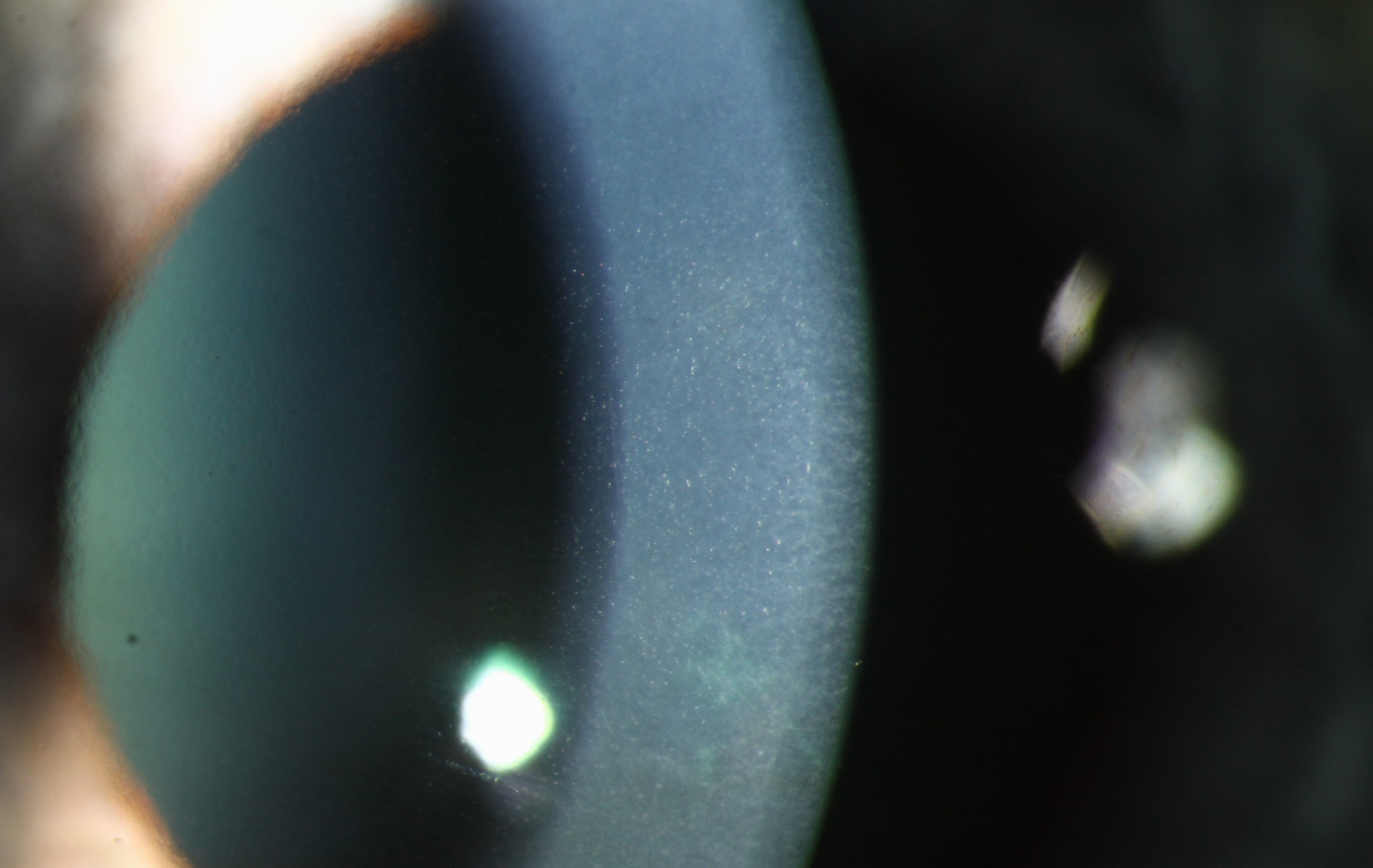 Clinical eye photograph illustrating Descemet Stripping Only