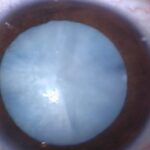 Clinical eye photograph illustrating Diabetes and Cataract