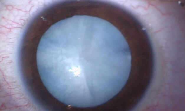 Diabetes and Cataract: Why Diabetic Patients Develop Lens Opacities Earlier and What It Means for Surgery
