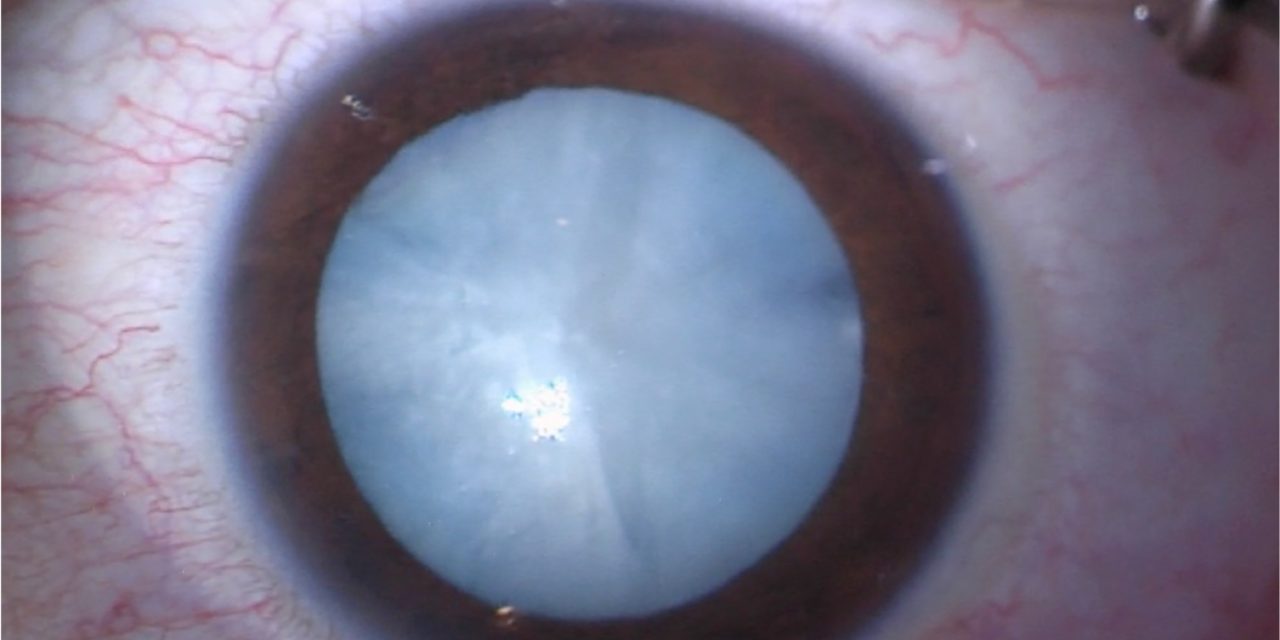 Diabetes and Cataract: Why Diabetic Patients Develop Lens Opacities Earlier and What It Means for Surgery