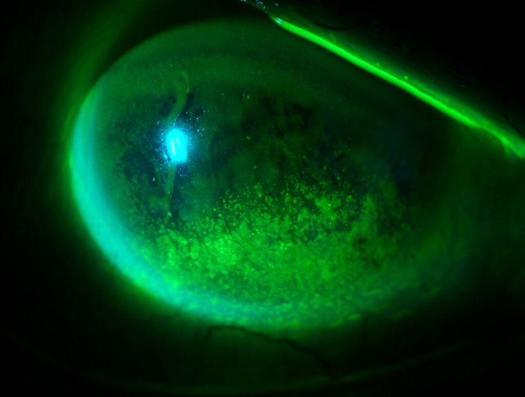 Clinical eye photograph illustrating Diabetic Keratopathy