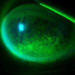 Clinical eye photograph illustrating Diabetic Keratopathy
