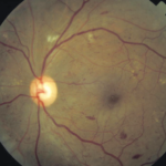 Clinical eye photograph illustrating Diabetic Retinopathy Classification