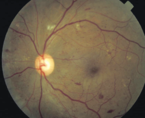 Clinical eye photograph illustrating Diabetic Retinopathy Classification