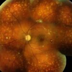 Clinical eye photograph illustrating Diabetic Retinopathy Kidney Disease