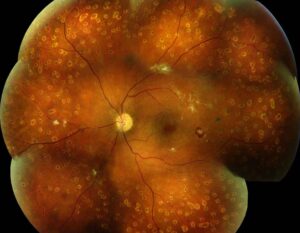 Clinical eye photograph illustrating Diabetic Retinopathy Kidney Disease