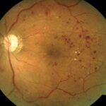 Clinical eye photograph illustrating Diabetic Retinopathy Screening Intervals Explained