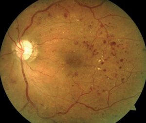 Clinical eye photograph illustrating Diabetic Retinopathy Screening Intervals Explained