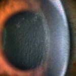 Clinical eye photograph illustrating Diffuse Lamellar Keratitis