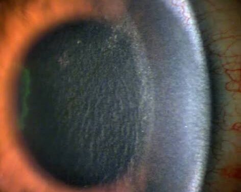 Diffuse Lamellar Keratitis: The Sands of the Sahara Under a LASIK Flap