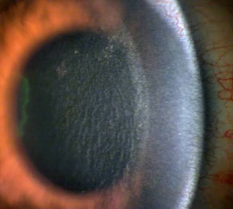 Clinical eye photograph illustrating Diffuse Lamellar Keratitis