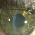 Clinical eye photograph illustrating Disciform Keratitis Herpetic