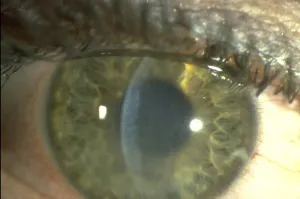 Herpetic Disciform Keratitis: When the Trouble Moves Into the Stroma