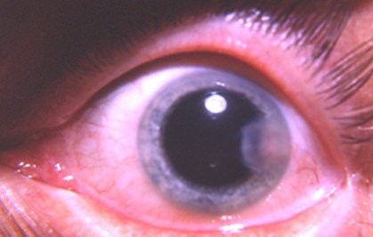 Clinical eye photograph illustrating Disciform Keratitis Herpetic