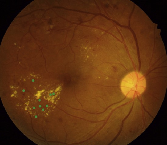 Clinical image illustrating DME Treatment (figure 1)