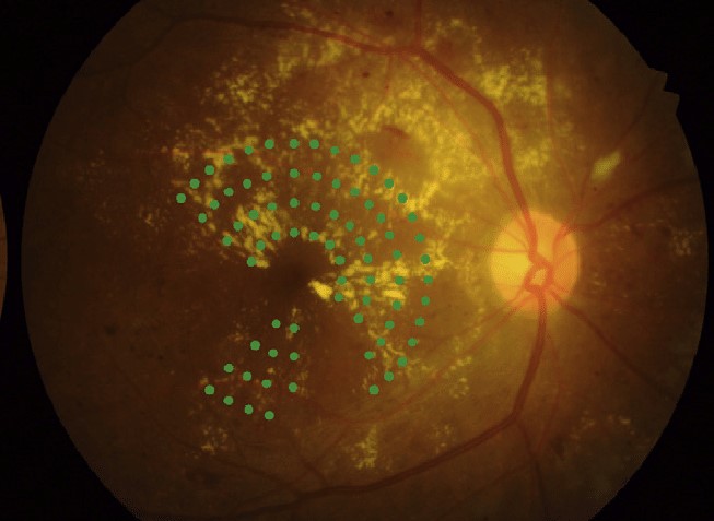 Clinical image illustrating DME Treatment (figure 2)