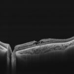 Clinical eye photograph illustrating Dominant Cystoid Macular Dystrophy Features