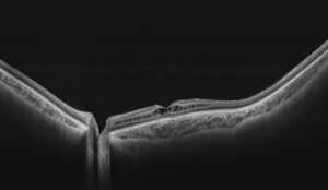 Clinical eye photograph illustrating Dominant Cystoid Macular Dystrophy Features