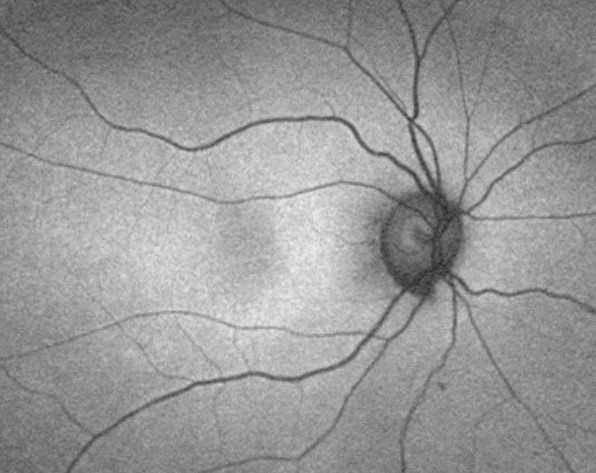 Clinical eye photograph illustrating Dominant Cystoid Macular Dystrophy Features