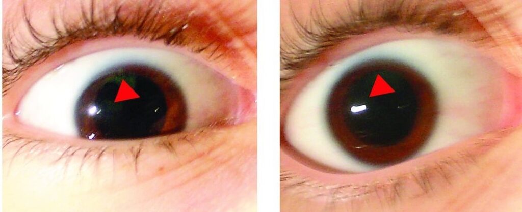 Clinical eye photograph illustrating Dorsal Midbrain Syndrome