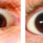 Clinical eye photograph illustrating Dorsal Midbrain Syndrome