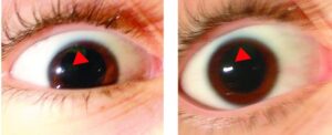 Clinical eye photograph illustrating Dorsal Midbrain Syndrome