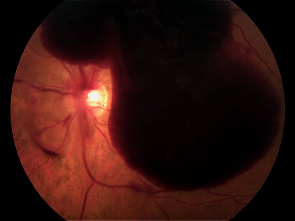 Clinical eye photograph illustrating Drcr Protocol Ab Vitreous Hemorrhage