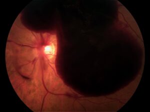 Clinical eye photograph illustrating Drcr Protocol Ab Vitreous Hemorrhage