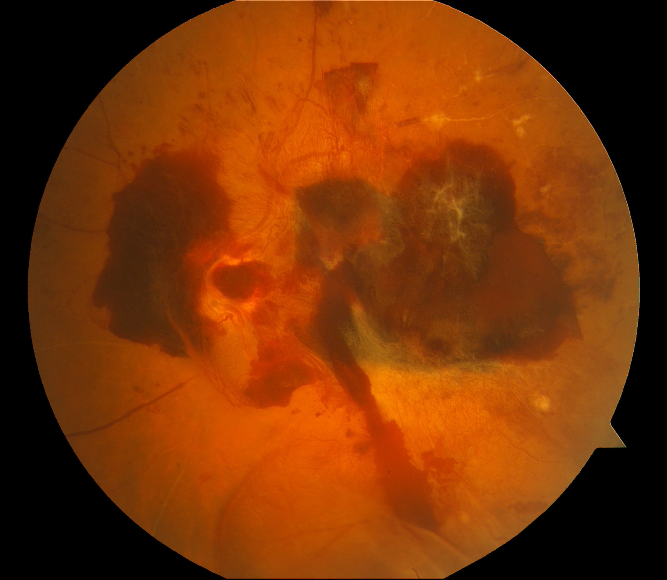 Clinical eye photograph illustrating Drcr Protocol Ab Vitreous Hemorrhage
