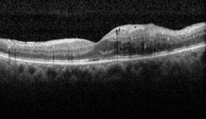 Clinical eye photograph illustrating Drcr Protocol I Ranibizumab Laser