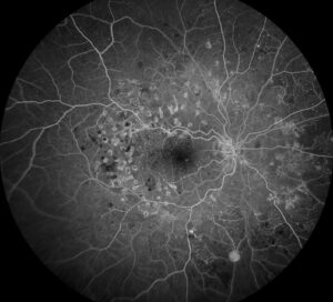 Clinical eye photograph illustrating Drcr Protocol S Prp vs Ranibizumab