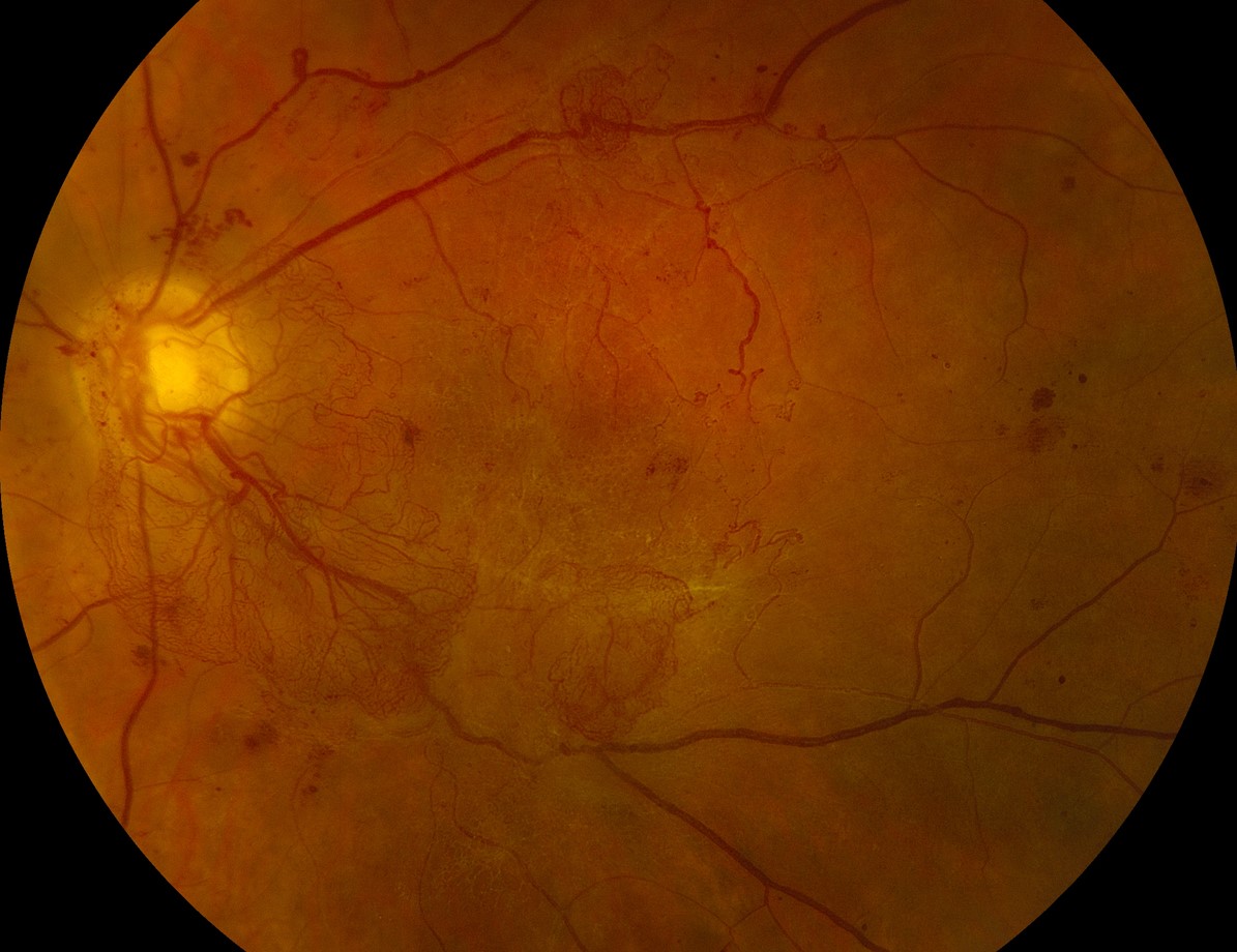 Clinical eye photograph illustrating Drcr Protocol S Prp vs Ranibizumab