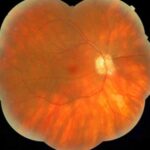 Clinical eye photograph illustrating Drug Induced Uveitis Checkpoint Inhibitors