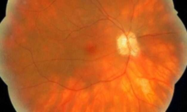 Uveitis After Checkpoint Inhibitor Therapy: Recognizing an Immune-Related Adverse Event