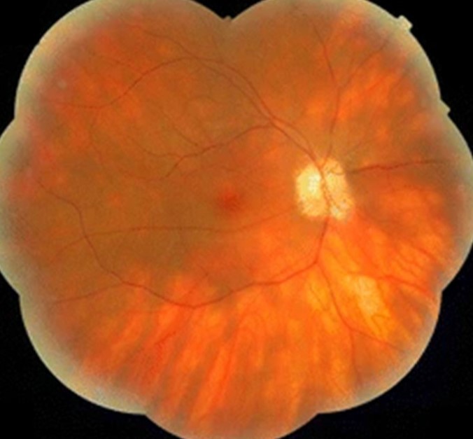 Uveitis After Checkpoint Inhibitor Therapy: Recognizing an Immune-Related Adverse Event