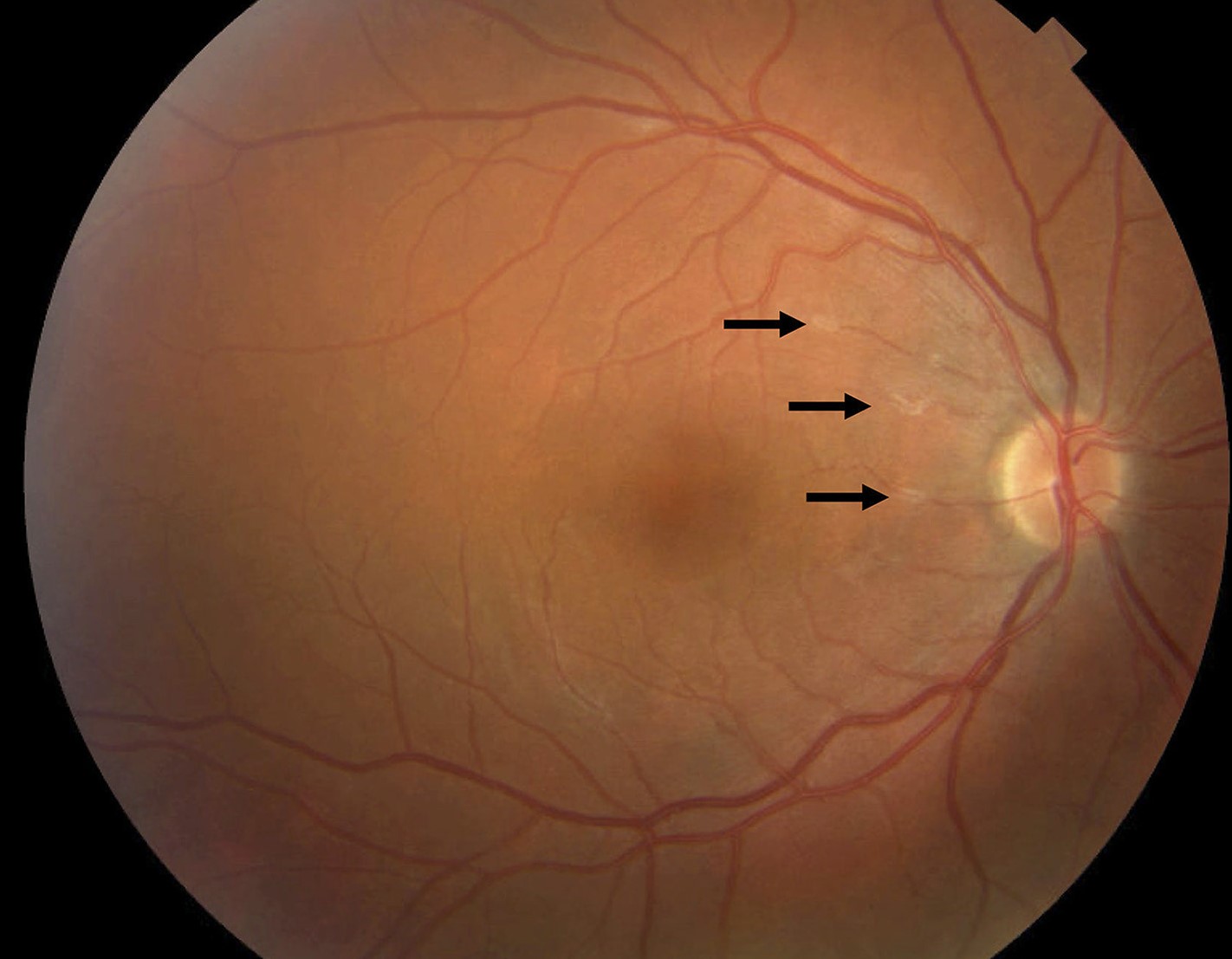 Clinical eye photograph illustrating Drug Induced Uveitis Checkpoint Inhibitors