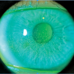 Clinical eye photograph illustrating Dry Eye After Lasik