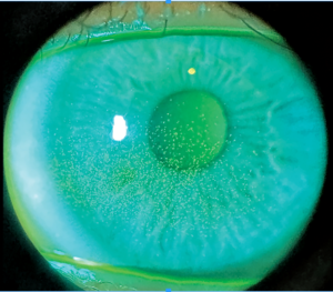 Clinical eye photograph illustrating Dry Eye After Lasik