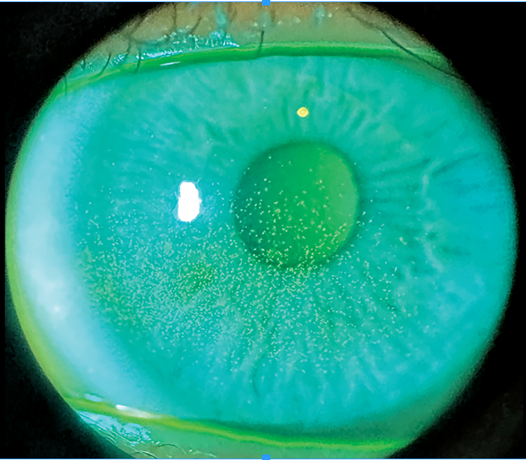 Clinical eye photograph illustrating Dry Eye After Lasik