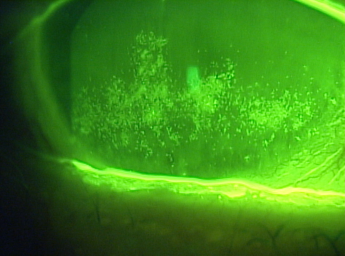 Clinical eye photograph illustrating Dry Eye After Lasik