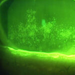 Clinical image illustrating Dry Eye Treatment
