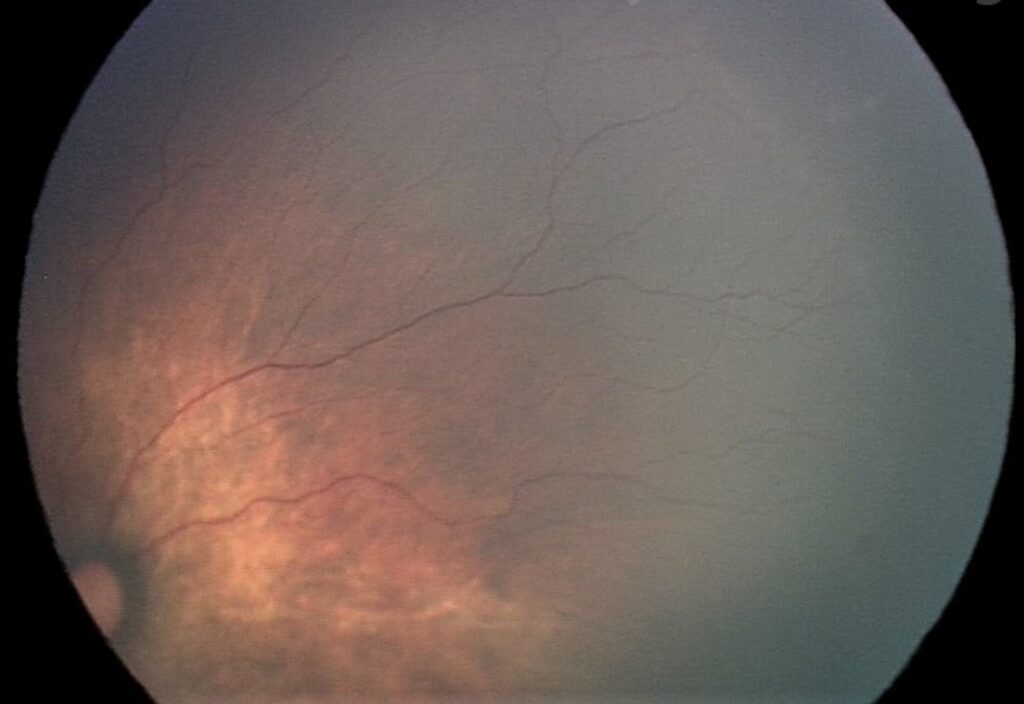 Early Treatment for Retinopathy of Prematurity (ETROP)