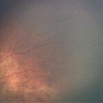 Clinical eye photograph illustrating Early Treatment Retinopathy of Prematurity Etrop