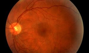 Clinical eye photograph illustrating Early Worsening Diabetic Retinopathy