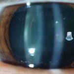 Clinical eye photograph illustrating Electric Cataract