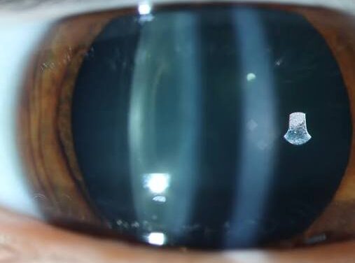 Electric Cataract: Lens Opacities After High-Voltage Injury and Lightning Strike